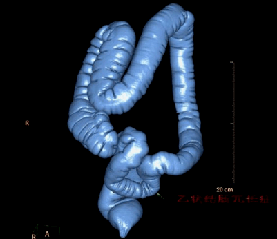 乙状结肠冗长症