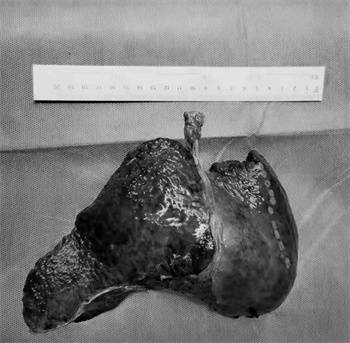 孙世波|哈医大二院多学科联合完成超声引导荧光腹腔镜下扩大左半肝切除