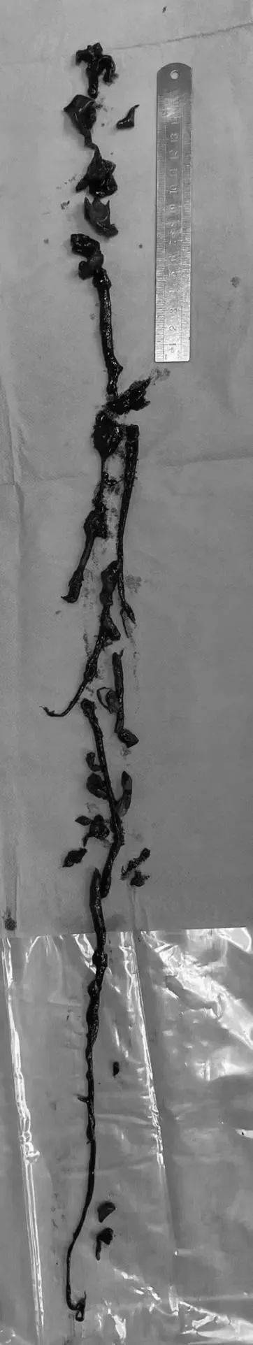 冠状动脉|广州64岁阿姨体内取出一米长的血栓！专家教你绕开这些“梗”……