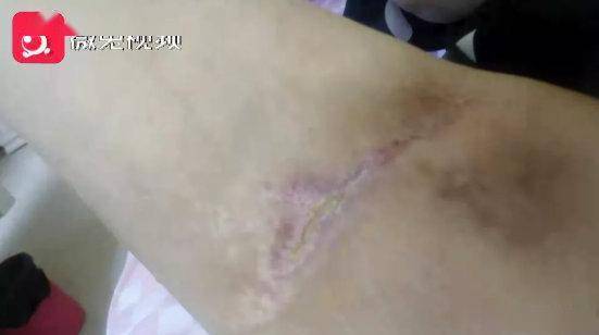 贵阳女子抽脂后皮肤大面积坏死 院方:暂不考虑赔偿