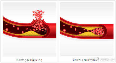 镜子|对着镜子做“120”测试，提前发现中风