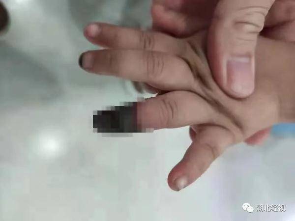 伤口|痛心！3岁女童竟因此被截掉手指