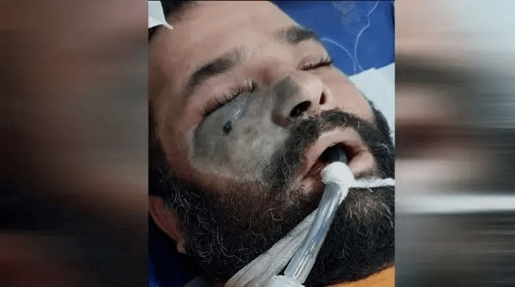 可怕疾病蔓延印度,致死率远超"新冠"_霉菌病