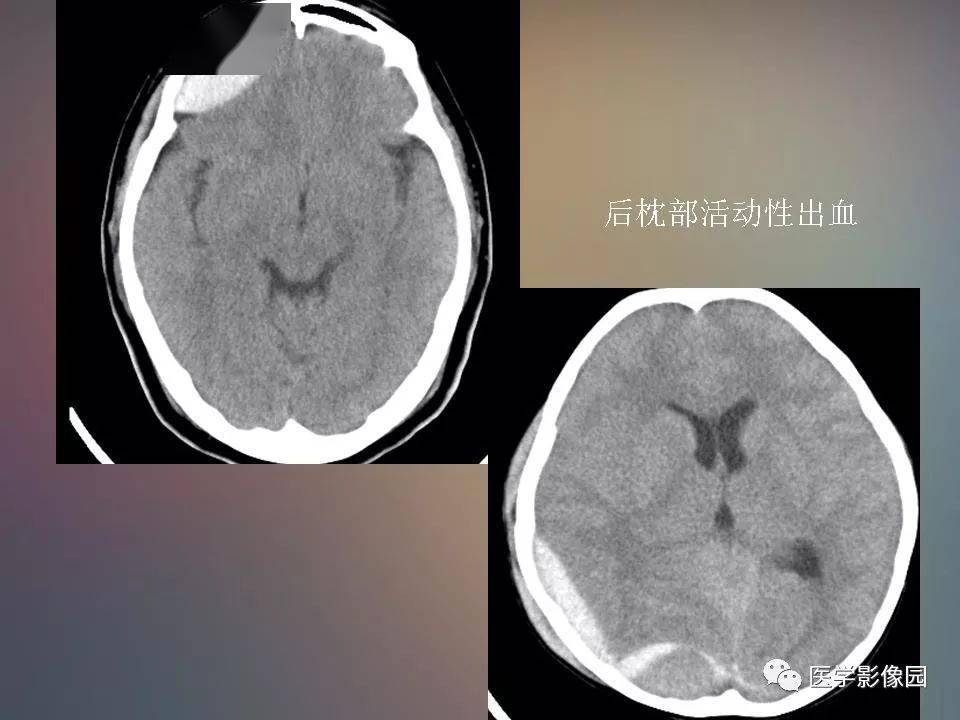 常见的急性颅脑损伤的ct和mri表现