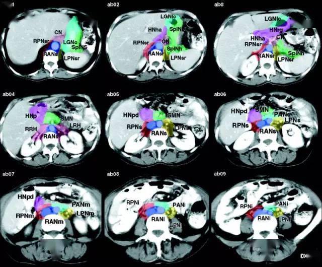 肿瘤医生必看:全身各区域淋巴结 ct 图谱