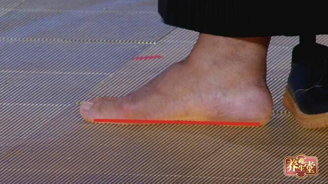 足部|隐藏在脚上的危险信号！