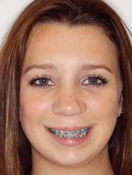 利用发育中的牙齿成骨