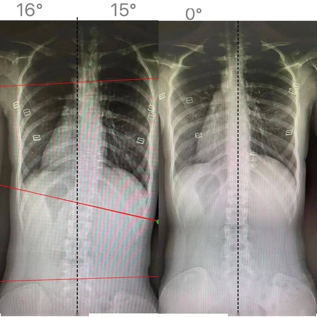 女孩脊柱侧弯10度照片图片