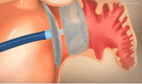 左心|多年房颤患者突发卒中、出血，双管齐下解决房颤血栓两大难题