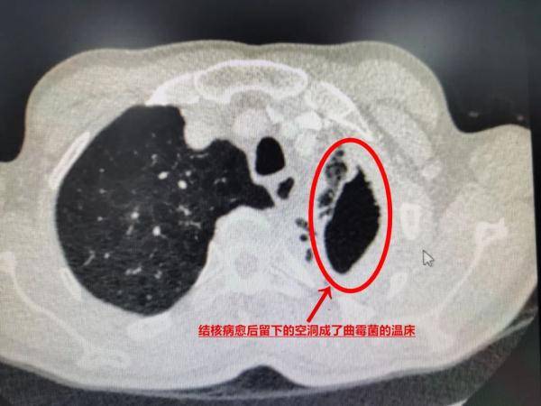 组织|一咳嗽就吐丝！竟是被空气中这种菌盯上了