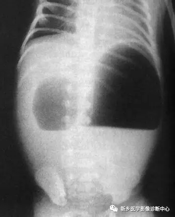 弹簧|图解21种腹部疼痛原因