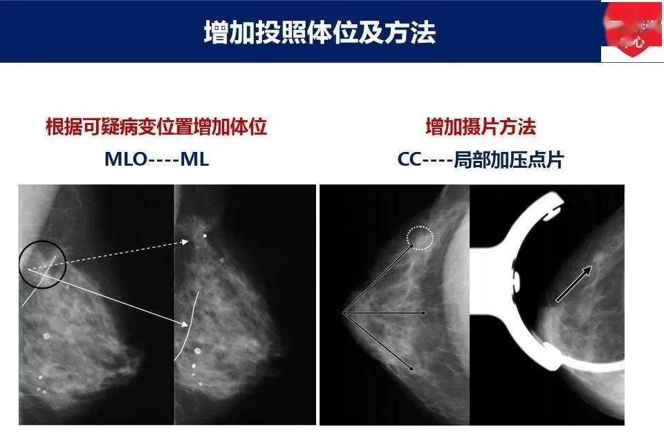 乳腺癌x線常見漏診及誤診