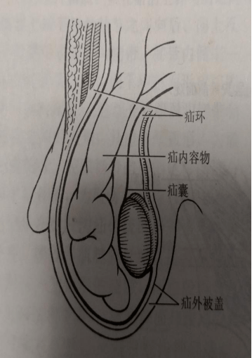 腹股沟区域腹壁存在缺损或者薄弱,腹腔内脏器经由其脱出而形成的包块