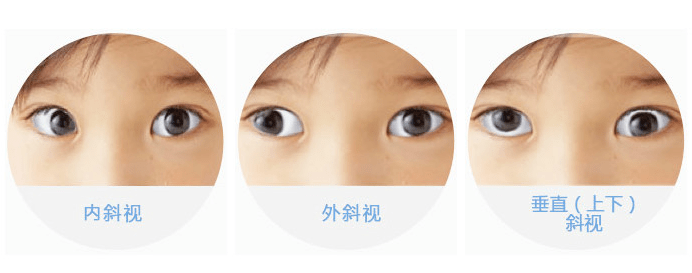 79复杂性斜视,如分离性垂直性斜视等.