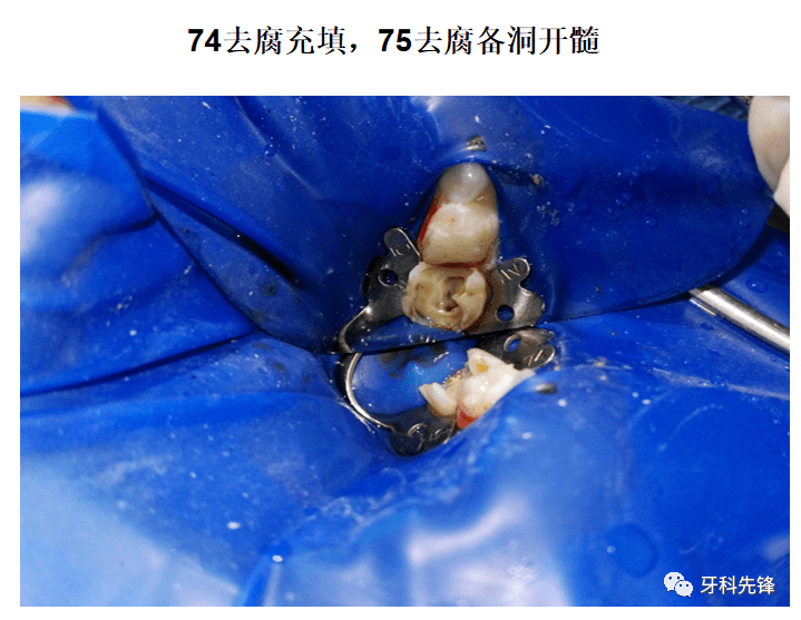 病例乳牙7585大面積齲壞根管治療金屬預成冠修復