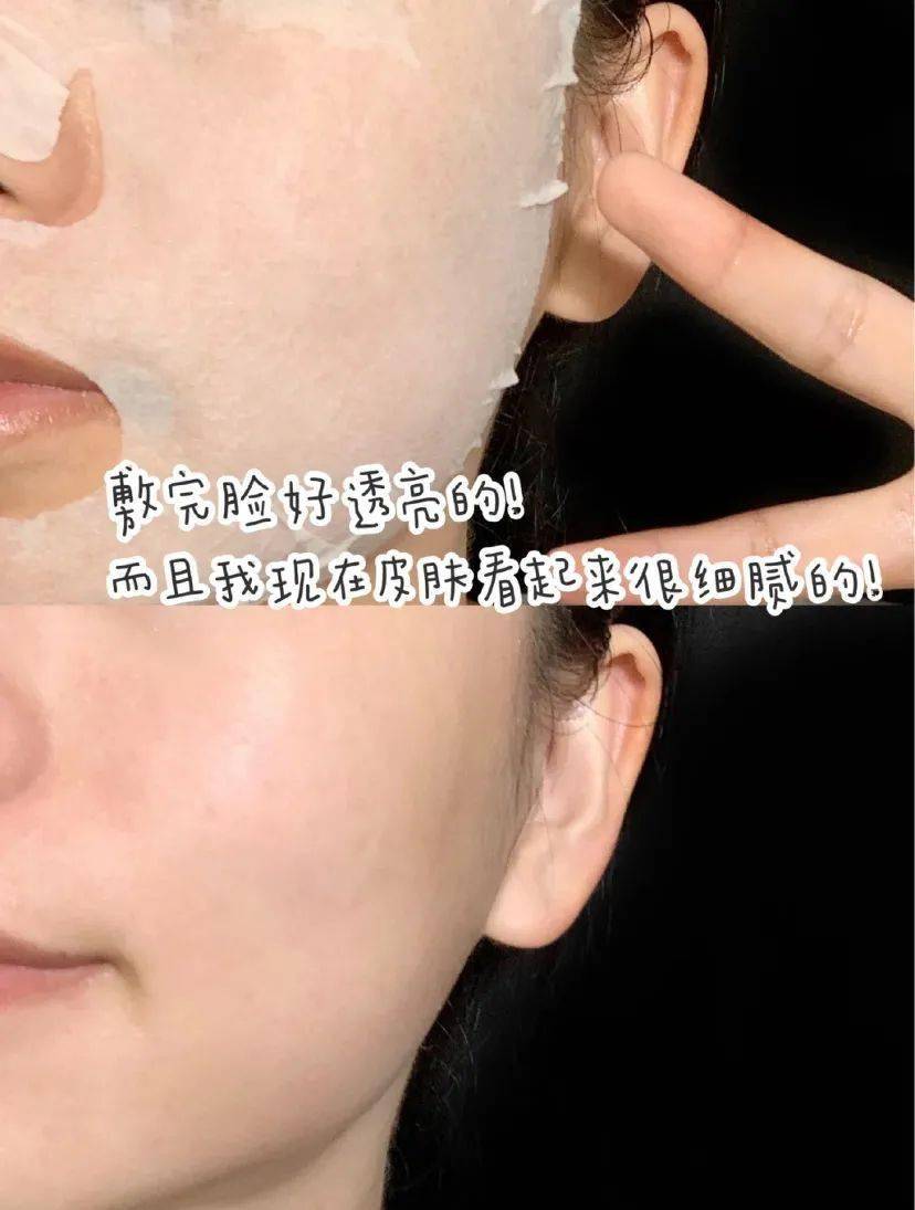 黑头|阿娇没骗我！2块钱敷一次酸，脸上“小疙瘩”竟被吞了！