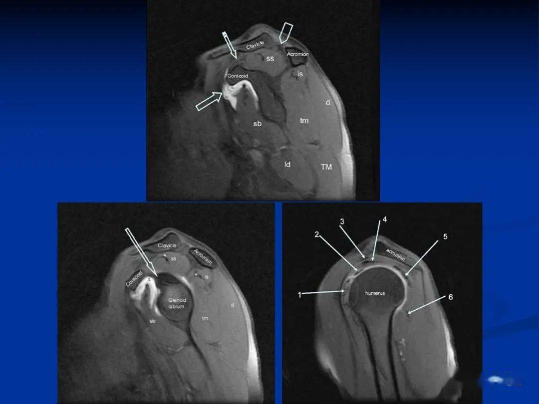 【經典】肩關節撞擊和肩袖撕裂高清圖解肩袖撕裂類型肩袖間隙的影像