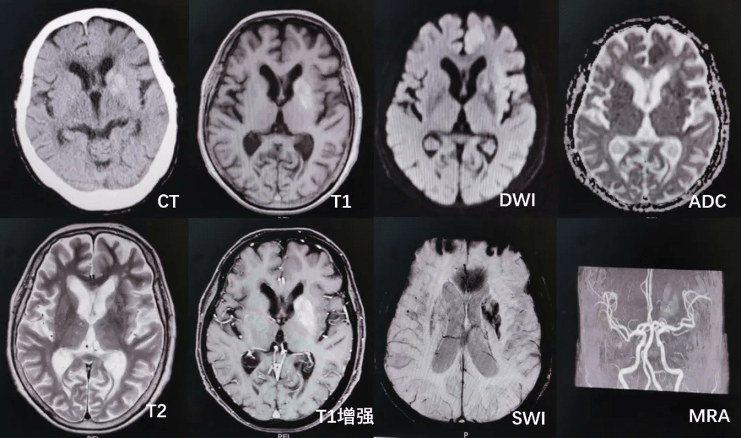 头颅mri示左侧基底节区尾状核头部及豆状核信号异常,金属盐沉积可能