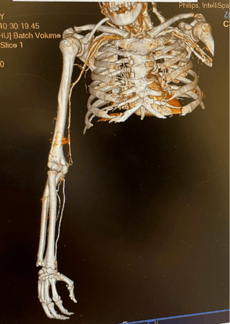 进行|【医患一家】精益求精,迎难而上,肾内科为血液透析患者重建“生命线”