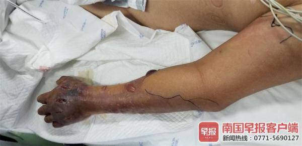 医学科|清洗海鱼时感染细菌，广西一老伯为保命遭截肢