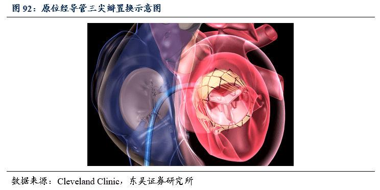 二尖瓣三尖瓣介入治療行業專題報告:百舸爭流,下一個黃金賽道誰主沉浮