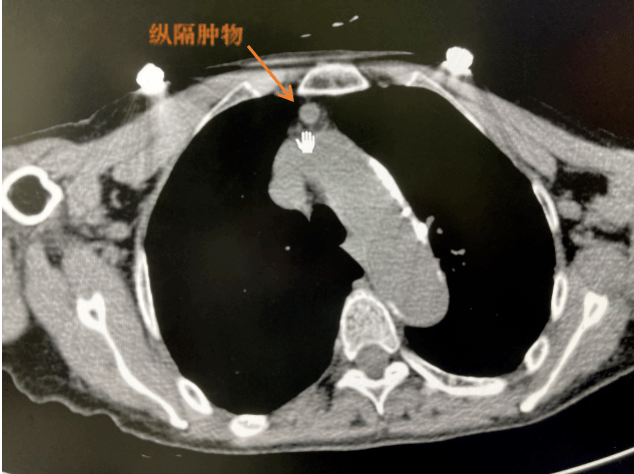 近期,钱奶奶到杭州市红十字会医院体检复查ct,发现五年前的前纵隔肿瘤