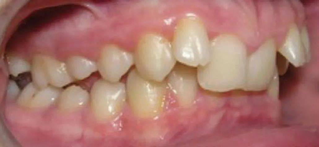 儿童安氏Ⅱ类错的特征与治疗_上颌