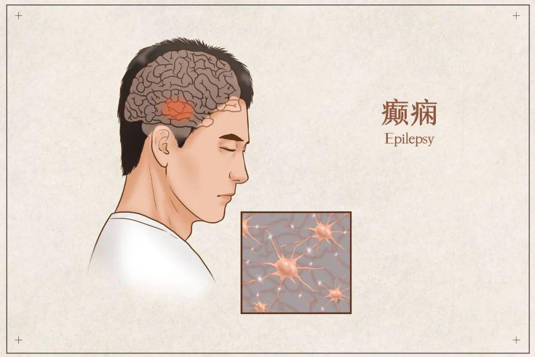 癫痫,俗称羊角风,是大脑的神经元异常放电导致的,患者的发作形式不一