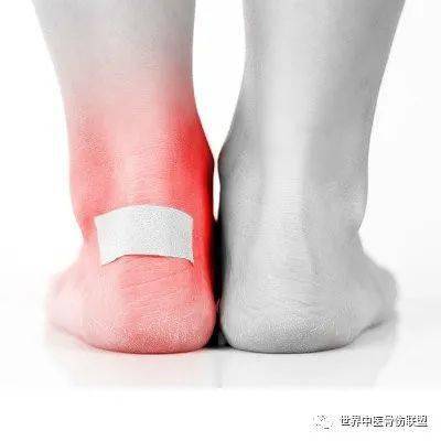 踝管综合征_症状