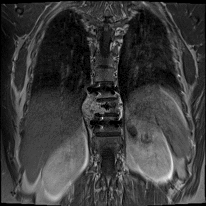 段长|脊柱多段长肿瘤业已压迫神经，中肿专家妙手拆弹抢救脊髓功能