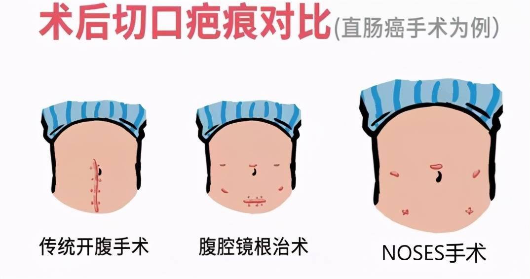 濮阳市油田总医院普外三科成功开展多例新技术noses手术