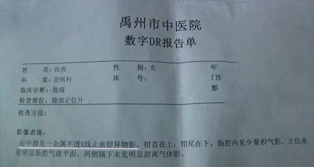 女子|止血钳遗留在女子腹中超15个月：院方否认，已被取出等鉴定