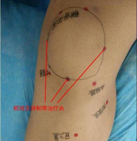 膝关节腔注射的定位图图片