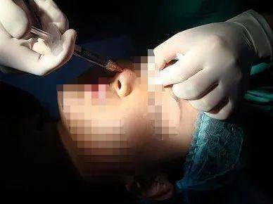 田诗政|注射违禁品、手术险丧命……女子求美变毁容！整形乱象遭曝光！