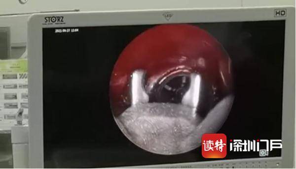 笔帽|惊险！10岁男孩跌倒，把笔帽吞了下去…