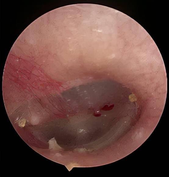 耳朵剧痛,竟是爬进这种东西.
