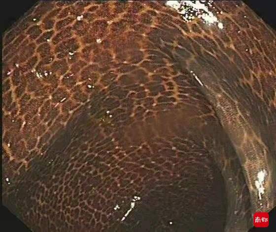 泻药|吃3年酵素肠子表面像蛇皮！这种通便、减肥法很多人在用