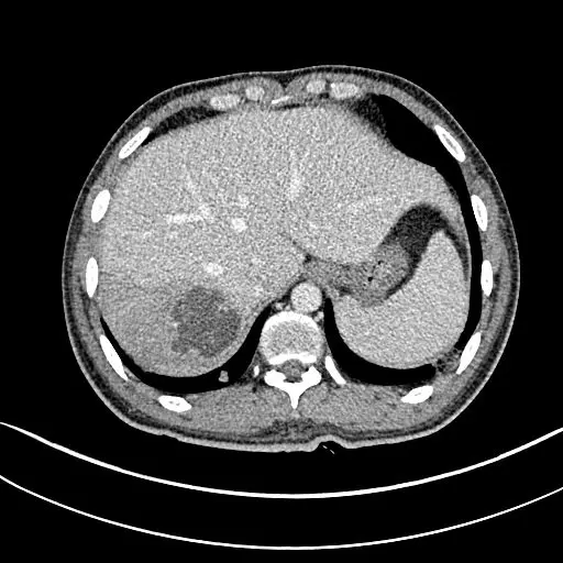什么|教你从肺CT上分辨是哪种细菌感染丨肺炎克雷伯杆菌篇