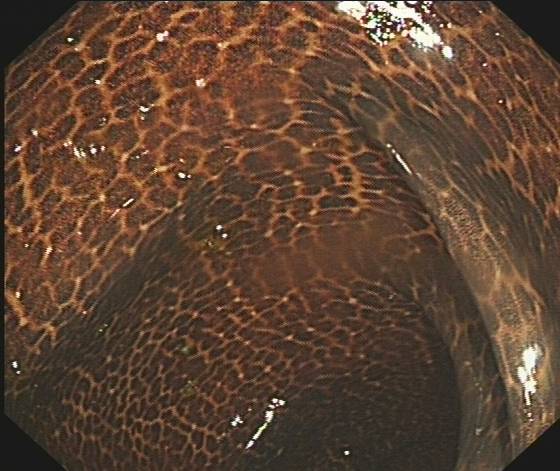 泻药|吃了三年酵素，一位奶奶的肠子表面如“蛇皮”，布满花纹