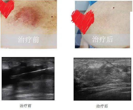 原因造成的乳汁淤积基础上,引发的乳腺炎症反应,临床表现为乳房疼痛