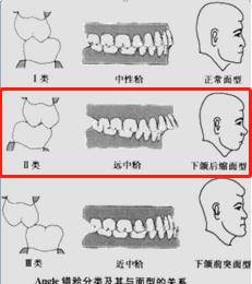 考试|小姑娘突然疼痛难忍、张不开口，医生说：这得治！
