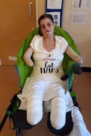 看牙医后留下小伤口女子因此被截去四肢毁掉半张脸