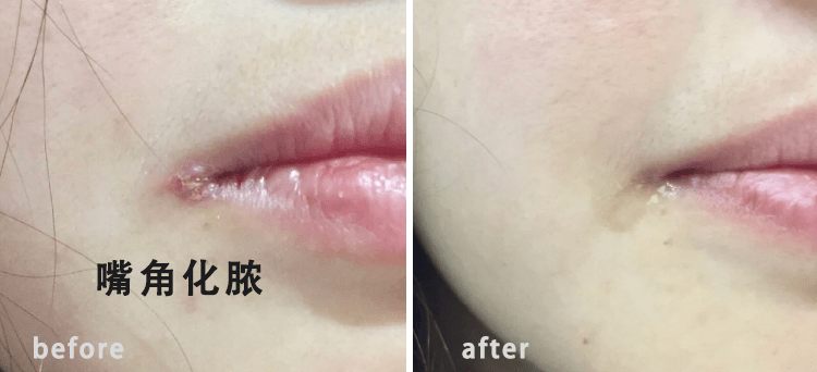 急救|唇纹又深又显老！急救起皮干裂，嘴巴像融化了一样，又软又糯贼滑溜！