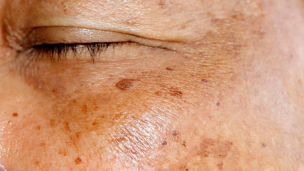 生活中常见的色斑有哪些呢？