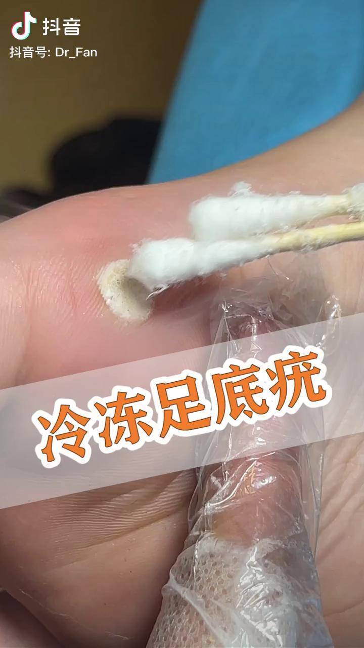 12歲的小朋友足底疣液氮冷凍雖然痛但是很勇敢樊哥撩皮膚疣知識創作人