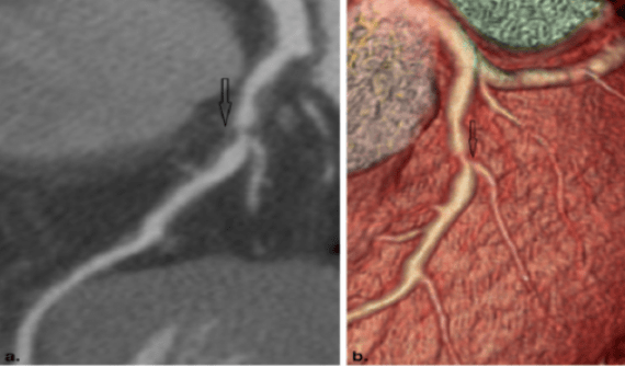 血管|全国科普日:医生靠什么评估冠心病