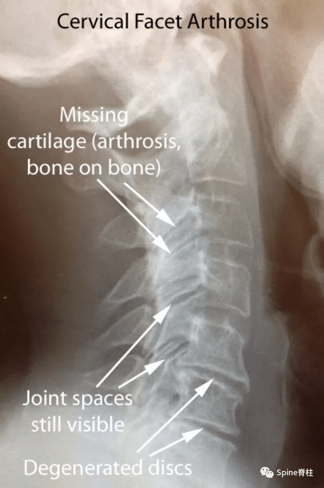 颈椎骨质增生x光片图片