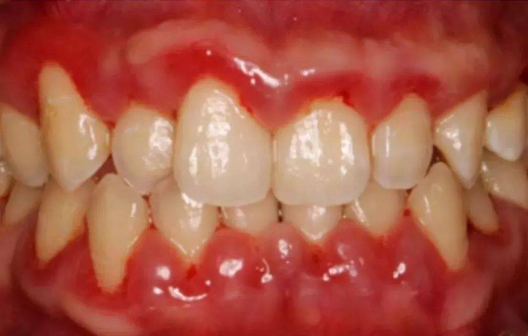 (严重牙周炎)2,作为牙周基础治疗,如果遇到牙周炎严重的,牙周袋会更深