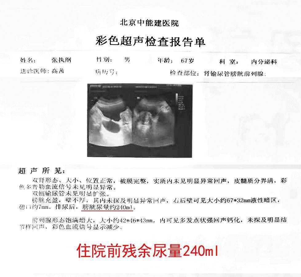 残余尿量由发病时的25ml发展到240ml,膀胱憩室67x32mm,憩口约7mm