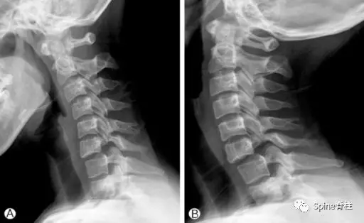 颈椎x线片能给我们诊断带来那些提示